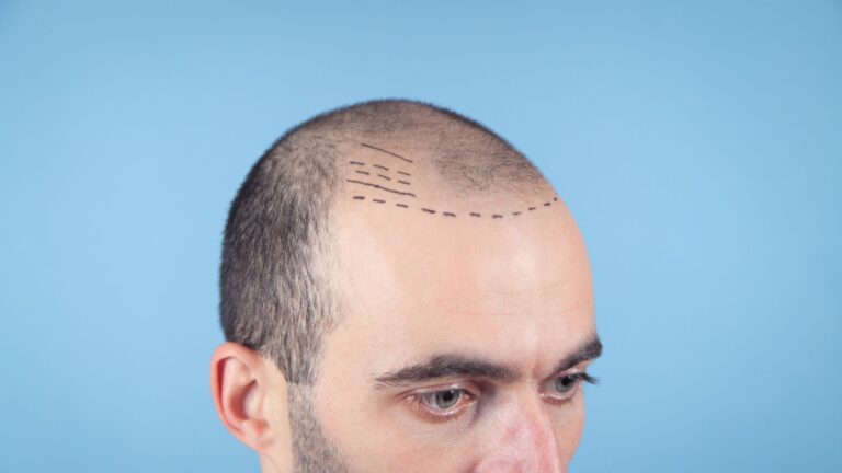 Przeszczep włosów – na czym polega i jakie są koszty?